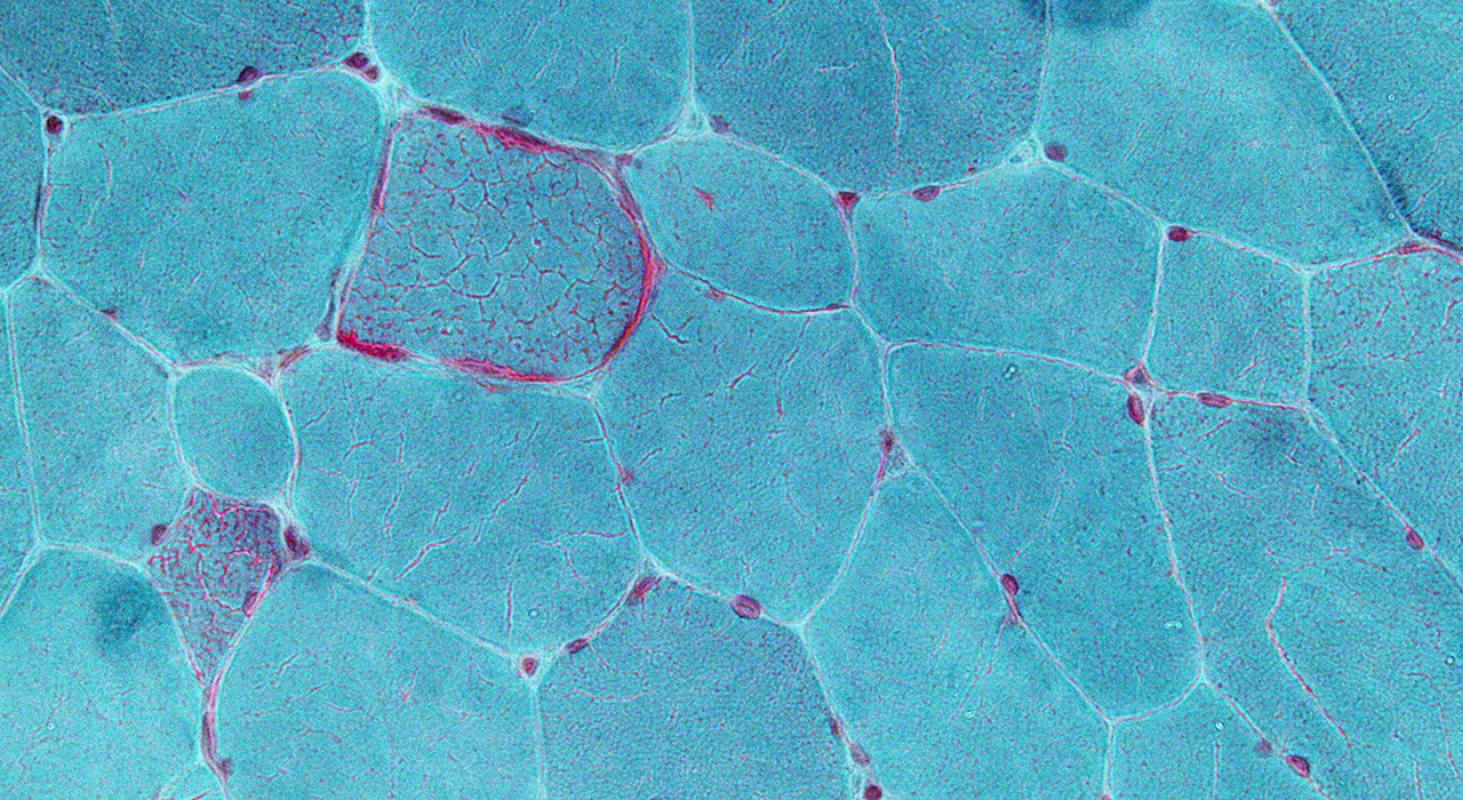 Postgraduate Certificate in Idiopathic Inflammatory Myopathies - TECH